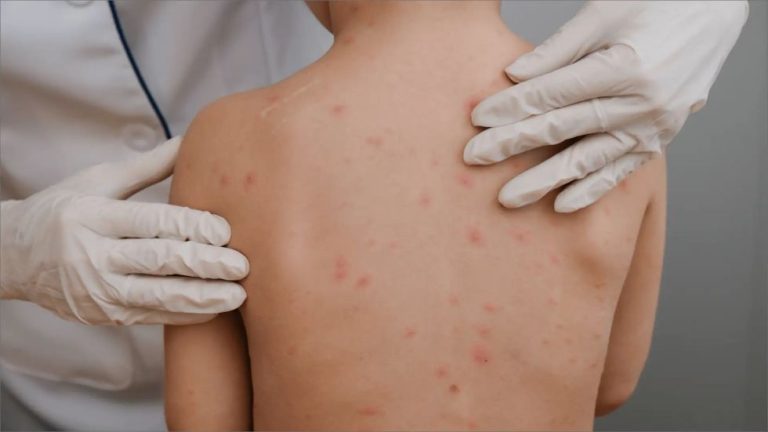 Varicela /Imagen de referencia/